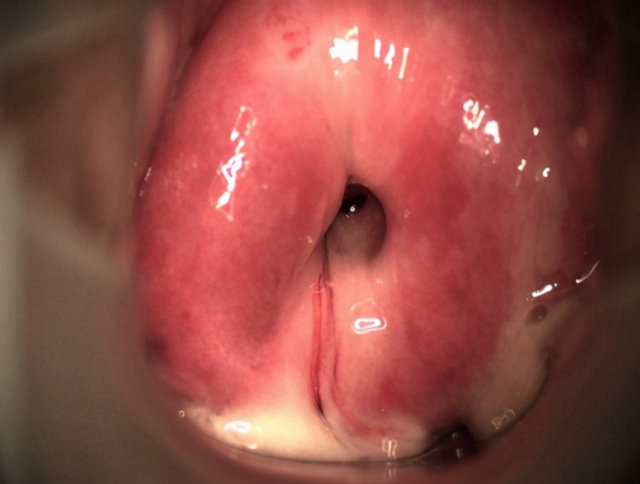 Hình ảnh viêm lộ tuyến cổ tử cung ở mức độ rất nặng (dịch âm đạo nhiều, vùng viêm lan rộng)